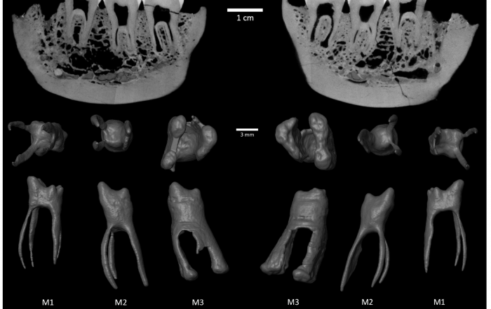 Parasagittal cut at the level of the right (right) and left (left) molars showing different grades of taurodontism with the virtual reconstruction of the pulp cavities.